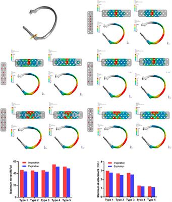 Finite element analysis of different fixation methods of screws on absorbable plate for rib fractures